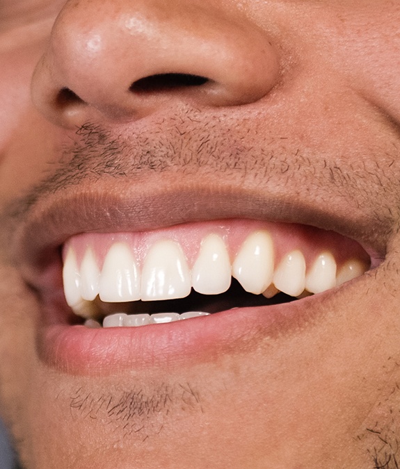 close up of man's smile after gum recontouring