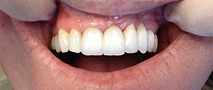 Patient 2 after replacing missing front tooth