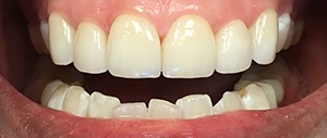 Patient 4 closeup of beautiful smile after treatment