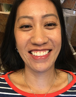 Patient 4 full face smile after treatment
