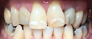 Patient 5 with discolored front teeth before