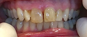 Patient 1 closeup smile with dark front teeth before