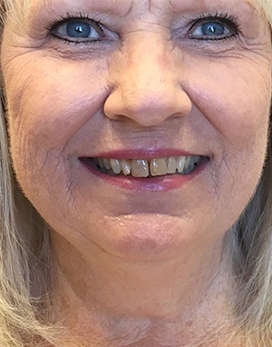 Patient 1 full face smile before treatment