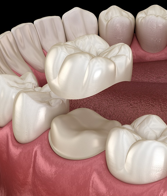 Illustration of dental crown being placed on tooth