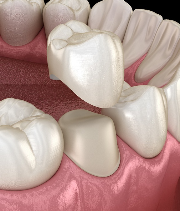 3D illustration of dental crown capping a tooth