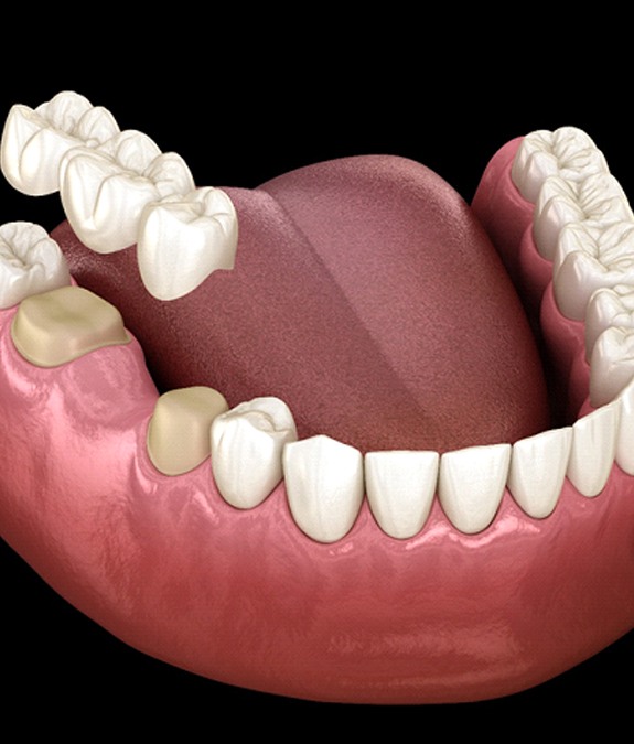 A digital image of a dental bridge going on over health teeth located on the lower arch of a person’s smile