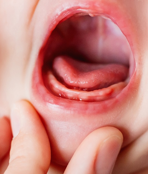 baby demonstrating why frenectomies in Mansfield are important