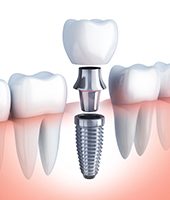 computer illustration single implant