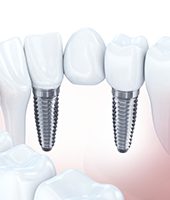 computer illustrated multiple implant