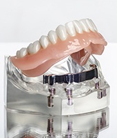 bottom denture implant model