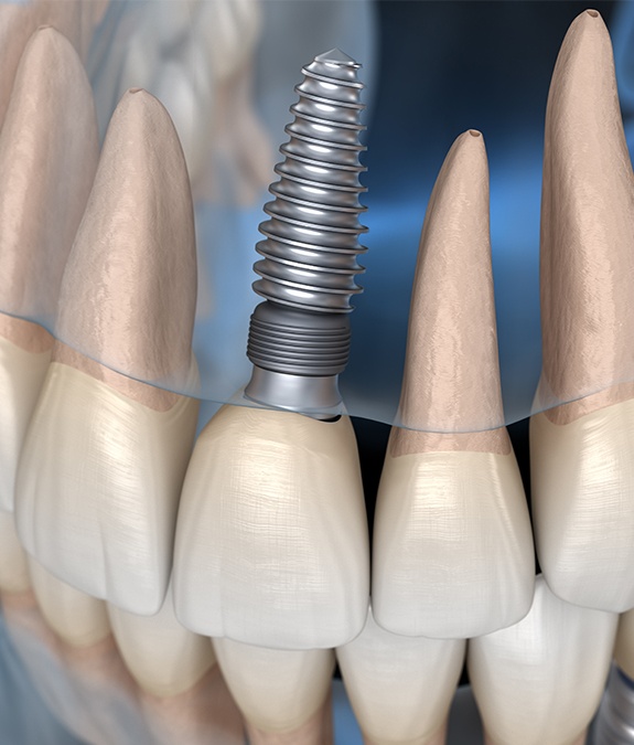 computer illustration of what implants look like under gums