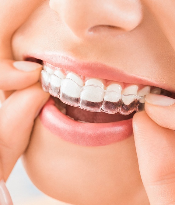 Close-up of woman placing Suresmile in Mansfield on teeth