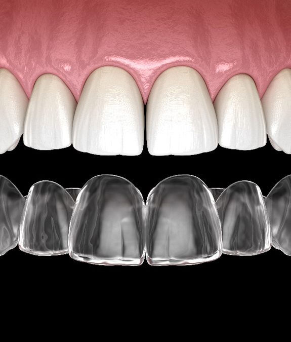 Illustration of SureSmile aligner being placed on upper dental arch
