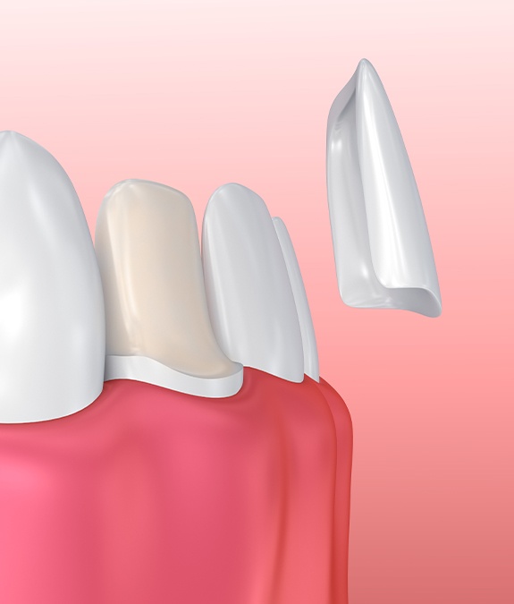 computer illustration of how porcelain veneers work