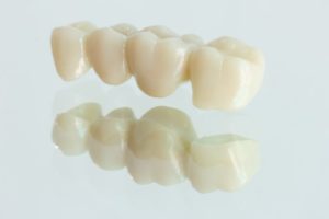 closeup of a dental bridge