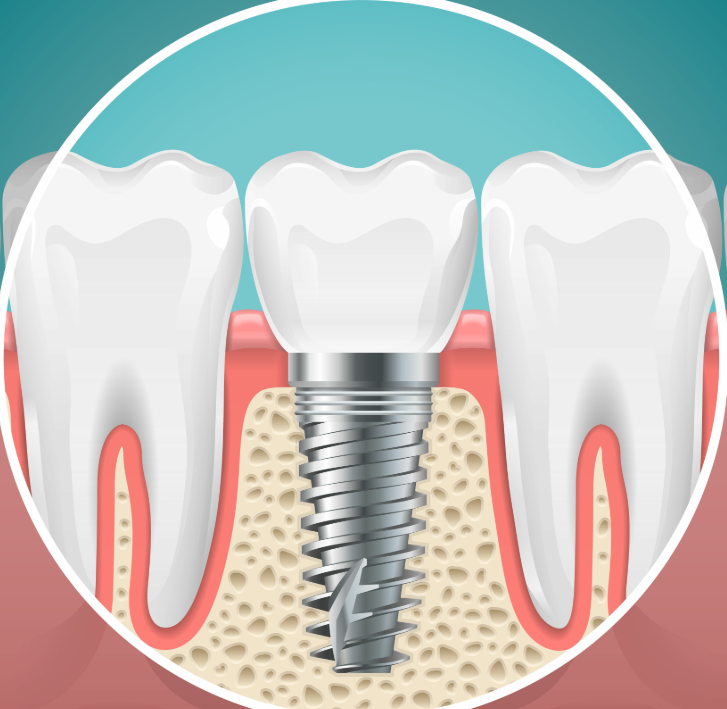 Illustrated cross section of a dental implant