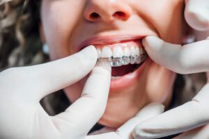 Gloved hands inserting fitting clear aligner on to patient’s upper arch.